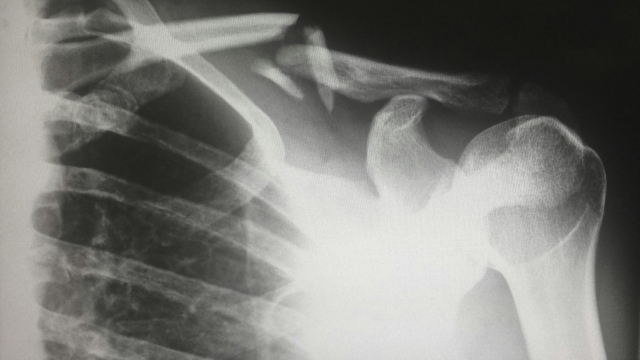 x-ray_bones_skeleton_unsplash